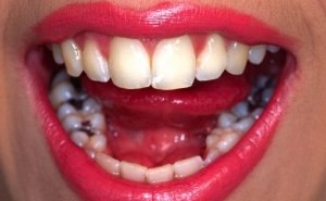 Black Fillings